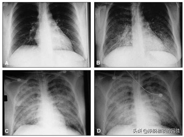 汉坦病毒最新动态，科学解读、预防策略与应对要点