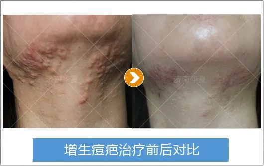 最新瘢痕治疗技术，小疤痕的奇遇与友情的治愈力量